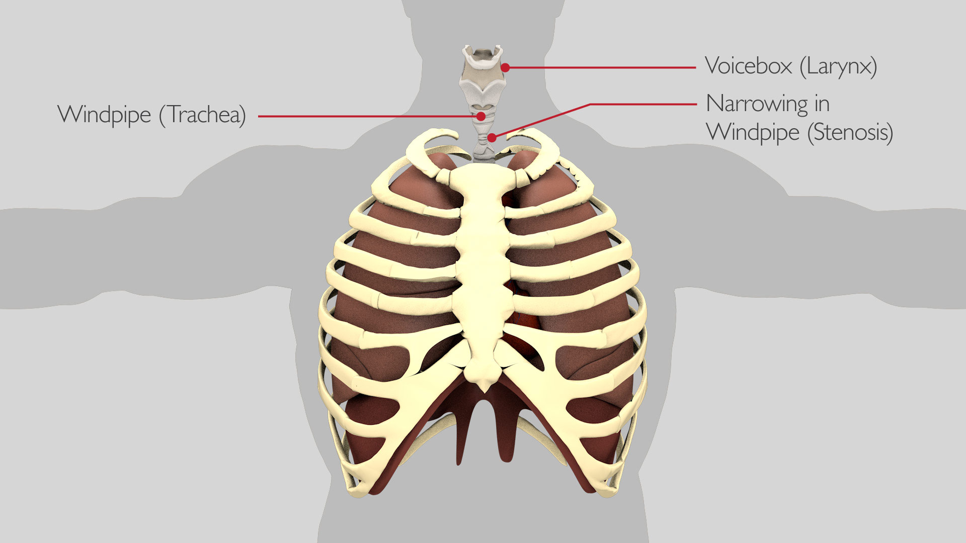 Tracheal Resection Thoracic Surgery University Hospitals Birmingham